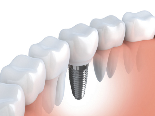 Dental implants Doncaster 