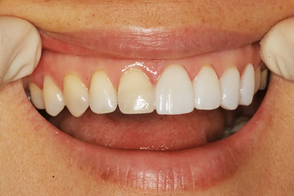 Veneers treatment