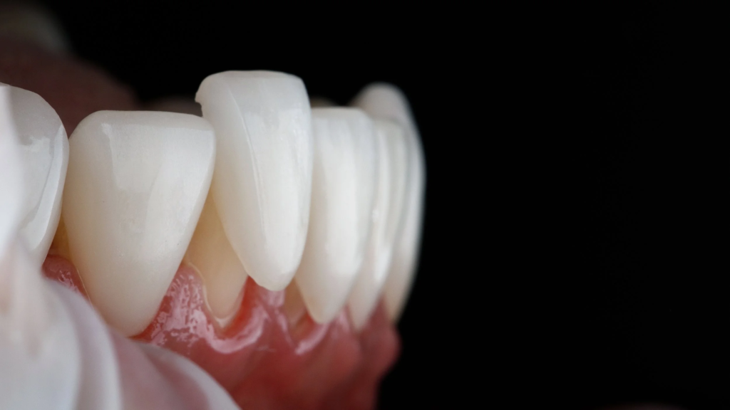 Do Veneers Ruin Your Real Teeth? Debunking the Biggest Myth