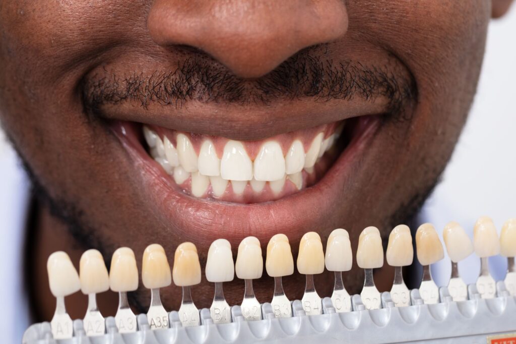 Veneers in Agoura Hills