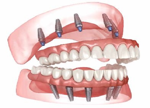 Full Mouth Reconstruction in Agoura Hills