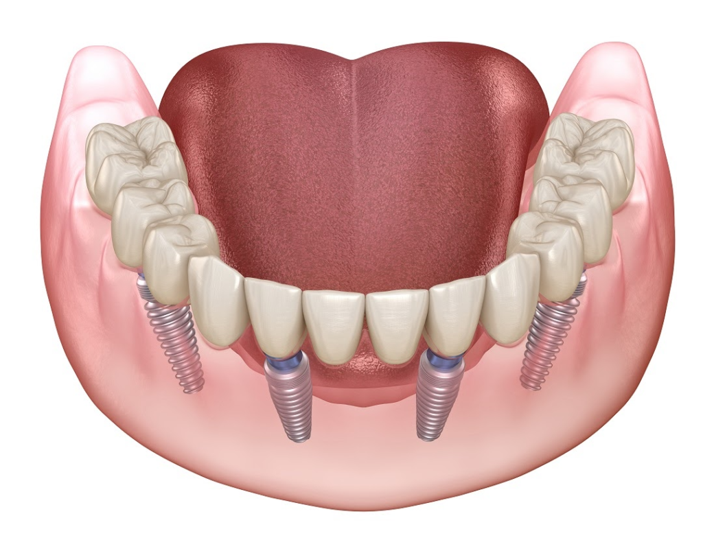 Full-mouth-Rehabilitation